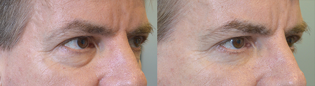 52 year old male physician, complained of looking tired with under eye puffiness and wrinkles. He underwent transconjunctival lower blepharoplasty with eye fat bags repositioning and skin pinch. Before and 2 months after cosmetic eyelid surgery photos are shown.
