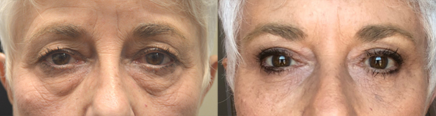 72 year old female, complained of looking older and tired with saggy droopy upper eyelids and eye bags. She underwent upper blepharoplasty, droopy upper eyelid ptosis surgery, transconjunctival lower blepharoplasty with fat repositioning with skin pinch and lateral pretrichial brow lift. Before and 3 months after eye plastic surgery photos are shown. (After photo is a selfie.)