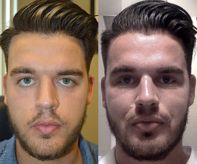 25 year old male, from Germany, underwent revision eyelid surgery to correct lower eyelid retraction after botched lower blepharoplasty. This was done using scarless inside eyelid approach with soof lift, canthoplasty, and alloderm spacer internal eyelid graft, plus additional orbital rim tear trough silicone implants. Before and 2 months after eye plastic surgery photos are shown. (After photo is a selfie.)