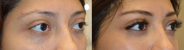 24 year old female, complained of bulging eyes and lower eyelid retraction with sclera show. She underwent NON-surgical upper eyelid filler and under eye filler injection. Before and 1 month after eyelid filler injection photos are shown.