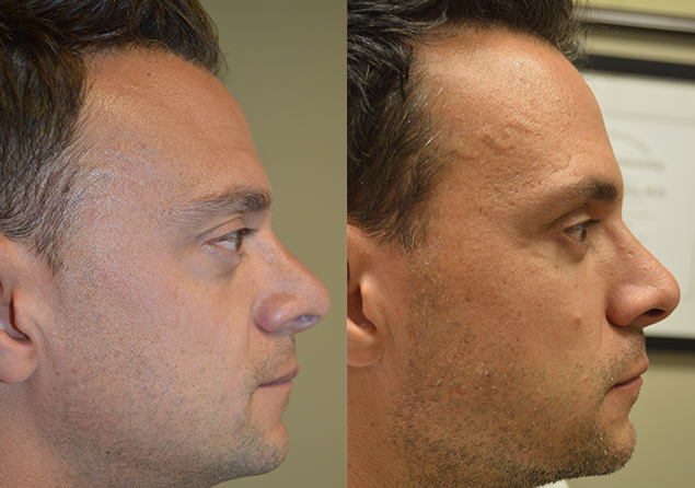 41 year old male, with inherited bulging eyes, underwent cosmetic orbital decompression, orbital rim silicone implant, and lower eyelid retraction surgery. Before and 4 months after eye plastic surgery photos are shown.