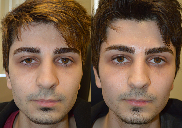 22 year old male, from Toronto Canada, complained of eye asymmetry with right eye smaller due to droopy right upper eyelid (ptosis). He underwent scarless internal right upper eyelid ptosis surgery. Before and 2 months after droopy eyelid ptosis correction photos are shown.