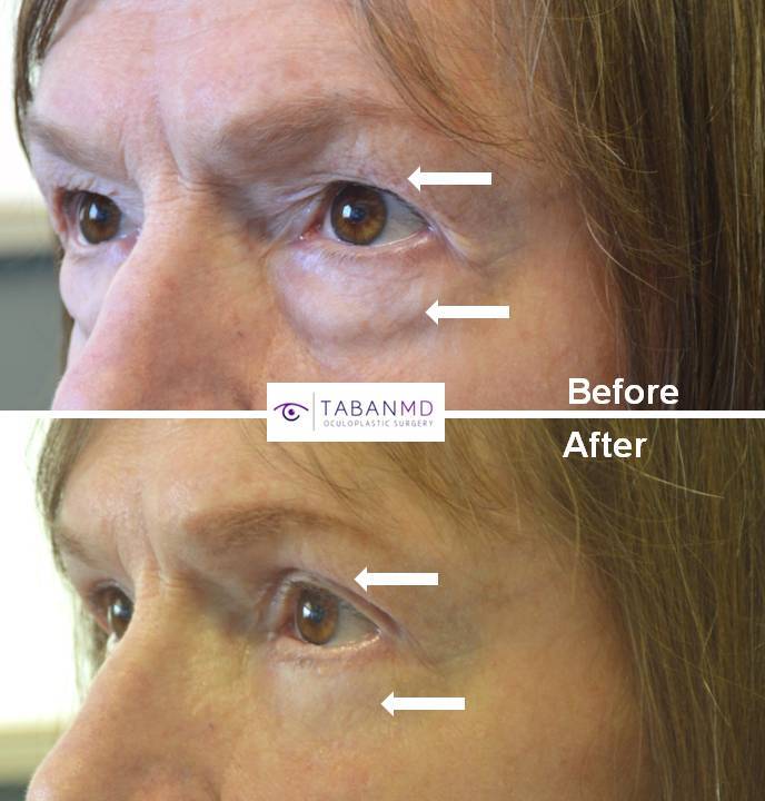 70+ year old female, complained of saggy upper eyelids and under eye bags, looking tired and older, underwent cosmetic male upper blepharoplasty and transconjunctival lower blepharoplasty (transconjunctival technique with eye fat bags repositioning to the tear tough area plus skin pinch), resulting in more rested youthful eye appearance with natural results.