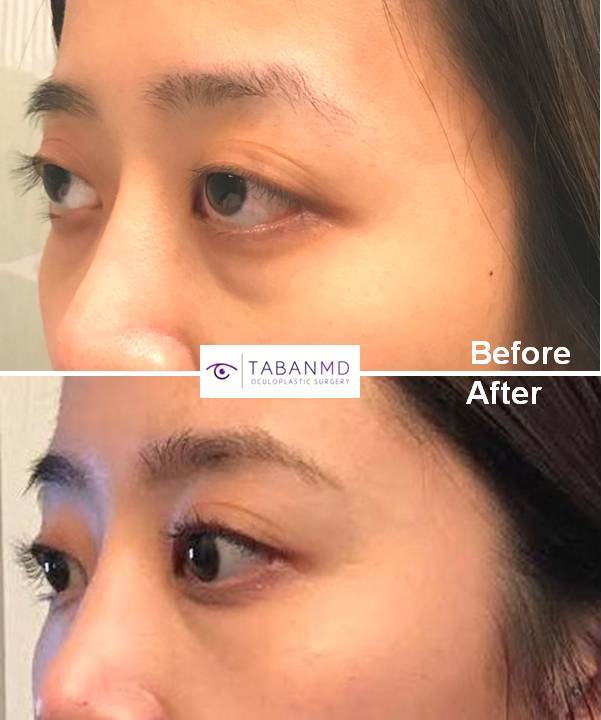 Young Asian female, complained of inherited protruding bulging eyes with lower eyelid retraction, with trouble closing eyes fully and unhealthy eye appearance. She underwent scarless orbital decompression surgery to treat bulging eyes combined with lower eyelid retraction surgery with canthoplasty to elevate the lower eyelids to eliminated scleral show. Before and 2 months after eye plastic surgery photos are shown.
