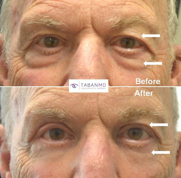 70+ year old male, complained of saggy upper eyelids and under eye bags, looking tired and older, underwent cosmetic male upper blepharoplasty and transconjunctival lower blepharoplasty (transconjunctival technique with eye fat bags repositioning to the tear tough area plus skin pinch), resulting in more rested youthful eye appearance with natural results.