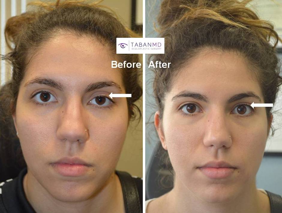 Young lady with congenital left droopy upper eyelid ptosis underwent scarless internal ptosis surgery. Before and 2 months after eyelid ptosis repair photos are shown. You can listen to her video testimonial on our testimonial page.