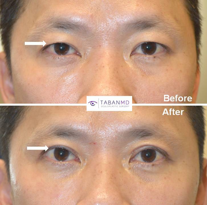 Asian man underwent cosmetic Asian upper blepharoplasty with crease formation. Asian blepharoplasty needs to consider the natural Asian eye shape and eyelid structures to provide natural results. Before and 3 months after cosmetic eyelid surgery photos are shown.