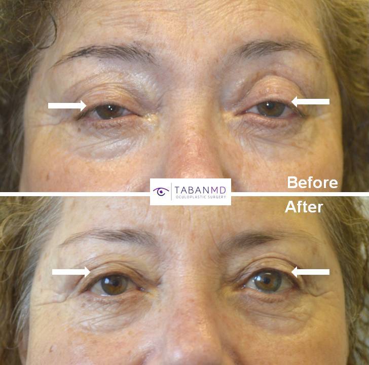 65+ year old female, with history of prior upper blepharoplasty (by another surgeon), complained droopy upper eyelids with trouble keeping eyes open. She underwent scarless internal droopy upper eyelid ptosis surgery, resulting in more natural rested eye appearance. Before and 2 months after eyelid plastic surgery photos are shown.