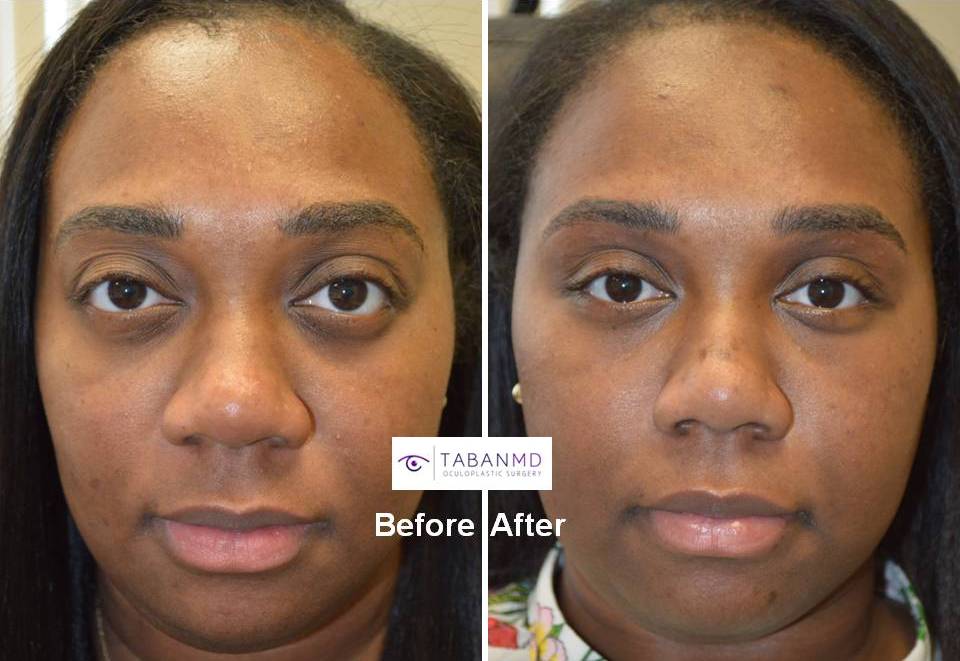 31 year old African American female, with inherited bulging eyes due to shallow orbits and lower eyelid retraction with sclera show. She underwent cosmetic orbital decompression and lower eyelid retraction surgery. Before and 3 months after transforming eye plastic surgery photos are shown.