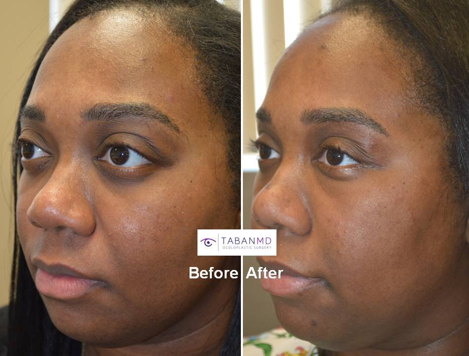 31 year old African American female, with inherited bulging eyes due to shallow orbits and lower eyelid retraction with sclera show. She underwent cosmetic orbital decompression and lower eyelid retraction surgery. Before and 3 months after transforming eye plastic surgery photos are shown.
