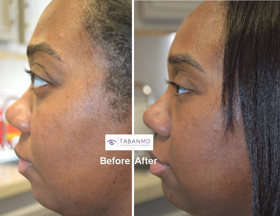 31 year old African American female, with inherited bulging eyes due to shallow orbits and lower eyelid retraction with sclera show. She underwent cosmetic orbital decompression and lower eyelid retraction surgery. Before and 3 months after transforming eye plastic surgery photos are shown.