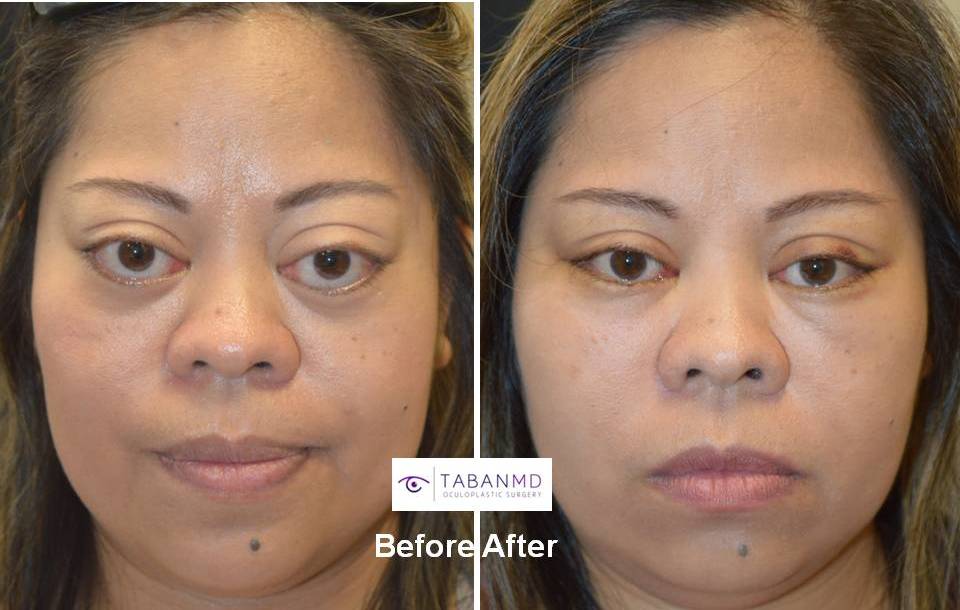 38 year old Asian female, with severe bulging eyes due to Graves thyroid eye disease, along with lower eyelid retraction with scleral show. She underwent combined orbital decompression surgery and lower eyelid retraction surgery. Before and 6 weeks after transforming eye plastic surgery photos are shown.
