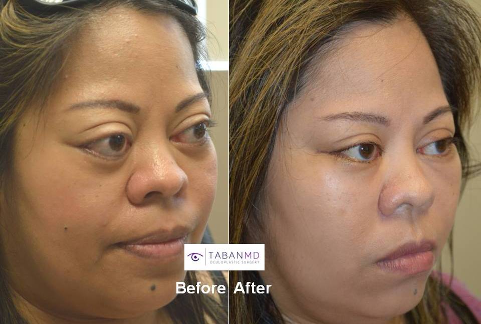 38 year old Asian female, with severe bulging eyes due to Graves thyroid eye disease, along with lower eyelid retraction with scleral show. She underwent combined orbital decompression surgery and lower eyelid retraction surgery. Before and 6 weeks after transforming eye plastic surgery photos are shown.