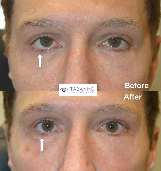 49 year old male, with history of multiple prior lower eyelid operations with resultant right lower eyelid retraction, underwent revision lower eyelid retraction surgery (internal approach, soof lift, alloderm spacer graft, canthoplasty). Before and 3 months after revisional eyelid surgery photos are shown.