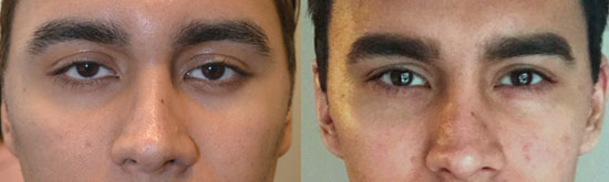 24 year old male, complained of looking sad and tired due to inherited lower eyelid retraction with negative canthal tilt and droopy upper eyelids (ptosis). He underwent almond eye surgery (lower eyelid retraction surgery using scar-less transconjunctival technique and canthoplasty) and upper eyelid ptosis repair. Before and 3 months after eye plastic surgery photos are shown. almond eye surgery
