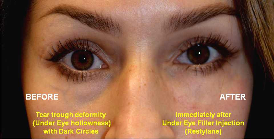 30 year old female, with under eye hollowness and dark circles from tear trough deformity complained of “looking tired" and makeup wasn’t enough. She underwent under eye filler (Restylane) injection. Before and Immediately After eyelid filler injection photos are shown, superimposed next to each other.