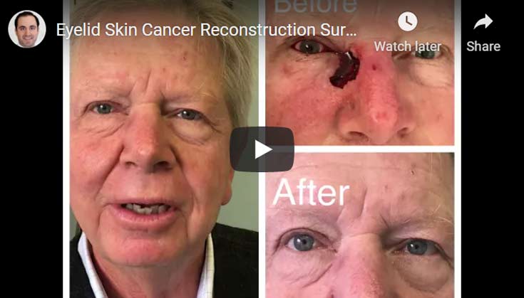eyelid-skin-cancer-reconstruction3
